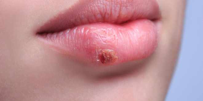 How to Get Rid of Cold Sores?