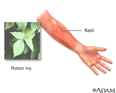 How long does poison ivy last