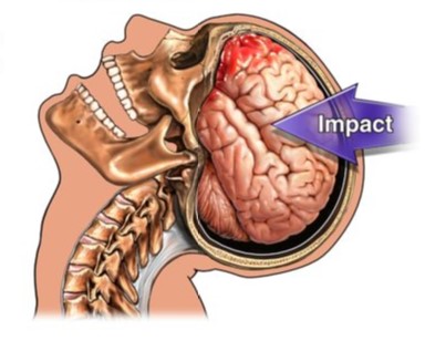 How to treat a concussion